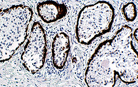 Prostate Cancer: CK5 — Anti-Rabbit HRP